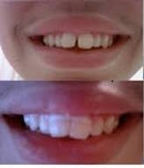 Cayenas Orthodontic Gap Teeth Bands 3/16 Heavy - 100 Bands Per Pack Cayenas Corporation