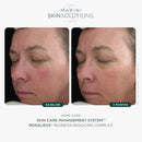 Marini SkinSolutions RosaLieve - Redness Reducing Face Lotion with Azelaic Acid & Tetrapeptide-14 - Cruelty Free - Made in the USA - 1 fl oz Infinity Warehouse