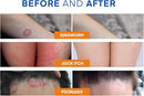 Antifungal Ringworm Treatment Body Wash - Antibacterial Wash with 1% Tolnaftate & Tea Tree Oil for Ringworm, Jock Itch, Tinea, Back Acne & Foot Odor on back, chest, groin, feet for Men and Women 500ml Infinity Warehouse