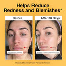 Foundation Skincare Azelaic Acid for Face 14% (1 Fl Oz) – Dermatologist Formula for Uneven and Blemish-Prone Skin, Supports Balanced Tone & Smooth Texture for Men & Women Infinity Warehouse