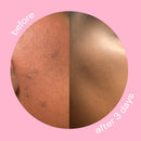 Peach Slices Dark Spot Micro Darts | For Dark Spots, Post-Blemish Redness, & Hyperpigmentation | Self-Dissolving | Niacinamide, Vitamin C, Hyaluronic Acid, and Cica | Vegan/Cruelty Free | 9 Patches Peach Slices