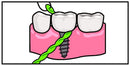IDontix Brace X-Floss, Green Idontix