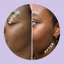 HYPERFADE by ZitSticka, Microdart Patch to Fade Post-Zit Dark Spots ZitSticka