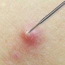 Beaute Galleria Needle Blackhead Remover Pimple Extractor Popper for Acne Comedone Blemish Whitehead Zit Removal Tool BEAUTÉ GALLERIA