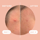 KILLA™ Kit by ZitSticka, translucent pimple patch for deep, early-stage zits, 4 pack ZitSticka