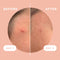 KILLA™ Kit by ZitSticka, translucent pimple patch for deep, early-stage zits, 4 pack ZitSticka