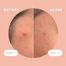 KILLA™ Kit by ZitSticka, translucent pimple patch for deep, early-stage zits, 4 pack ZitSticka