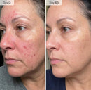 Micro Infusion System for Face & Neck-Micro Infusion Kit to Leave Skin Firmer & Smoother-0.25mm Facial Stamp with Collagen & Hyaluronic Acid Serum for At Home Glow and Anti-aging-3 Month Supply Infinity Warehouse