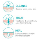 CeraVe Acne Foaming Cream Cleanser | Acne Treatment Face Wash with 4% Benzoyl Peroxide, Hyaluronic Acid, and Niacinamide | Cream to Foam Formula | 5 Oz CeraVe