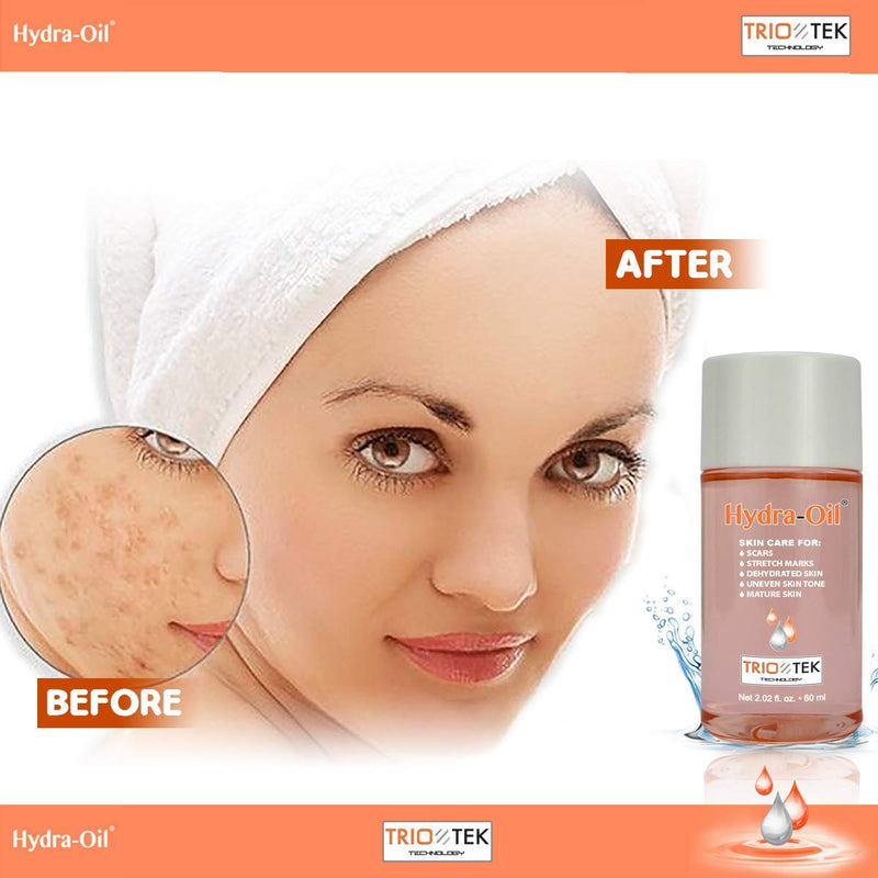 Hydra-Oil Scar Removal Serum - Scar Treatment for Face and Body - 50 ml Hydrating Oil for Acne Scar Remover, Stretch Mark Removal, and to Lighten Dark Spots - Vitamin E & A Hydra Oil