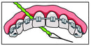 IDontix Brace X-Floss, Green Idontix