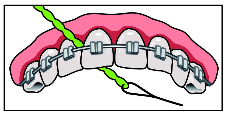 IDontix Brace X-Floss, Green Idontix