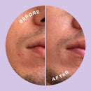 HYPERFADE by ZitSticka, Microdart Patch to Fade Post-Zit Dark Spots ZitSticka