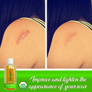 Bio Pure Skincare Oil, Vitamin E Oil for Scars, Body Oil For Stretch Marks, Acne Scar Remover, Stretch Mark Cream for Pregnancy - Scar Cream For Surgical Scars With Sweet Almond Oil and Omega 3 (8oz) Honeyskin
