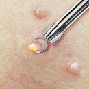Beaute Galleria Needle Blackhead Remover Pimple Extractor Popper for Acne Comedone Blemish Whitehead Zit Removal Tool BEAUTÉ GALLERIA