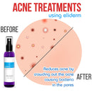 Topical Probiotic Spray For Skin - 13 Strains Live Probiotic Skin Care Dermatic Biome Acne Folliculitis Supplement Dermatitis Rosacea Eczema Treatment Body Face Mist Sprayable Deodorant Microbiome Infinity Warehouse