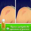 Bio Pure Skincare Oil, Vitamin E Oil for Scars, Body Oil For Stretch Marks, Acne Scar Remover, Stretch Mark Cream for Pregnancy - Scar Cream For Surgical Scars With Sweet Almond Oil and Omega 3 (4oz) Honeyskin