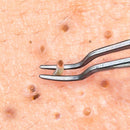 Beaute Galleria Premium Stainless Steel Bend Curved Blemish Extractor Tool for Remove Comedones Whitehead Blackhead Acne Pimple BEAUTÉ GALLERIA