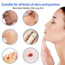 Skin Tag Remover, Safe and Painless Skin Tag Removal Kit for Face, Neck, Finger and Body, Smooth Results Small to Medium (0.08 to 0.2 in) Sized Skin Tags HomeSimlife