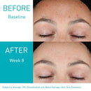 CeraVe Retinol Serum for Post-Acne Marks and Skin Texture | Pore Refining, Resurfacing, Brightening Facial Serum with Retinol | Fragrance Free & Non-Comedogenic| 1 Oz CeraVe