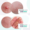 192 Count (4-Pack of 48) LivaClean Pimple Patch, Acne Absorbing Spot Treatment, Overnight Treatments Clear Dots To Get Rid Of Pimple, Zits, Blemish, Avoid Pimple Scars, Sizes: 8mm, 10mm, 12 mm LivaClean