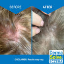 Dermasolve Eczema Relief Shampoo - Flare Control Scalp & Dandruff Free Therapy That Protects, Moisturizes, and Repairs Skin for Kids & Adults - Steroid Free (2-Pack) Infinity Warehouse