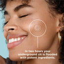 KILLA™ Kit by ZitSticka, translucent pimple patch for deep, early-stage zits ZitSticka