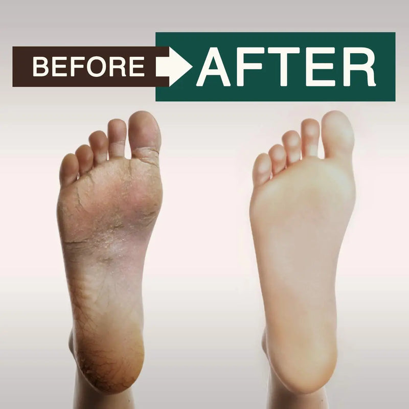 Tea Tree Oil Body Wash - Antifungal - Antibacterial Soap-Helps Athletes Foot - Toenail Fungus - Ringworm - Jock Itchy - Acne - Eczema - Yeast Infection - Body Odor - Itchy Skin - Sulfate Free - 16oz ORISO