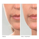 Michael Todd Beauty - Sonicsmooth Replacement Kit for At-Home Dermaplaning - 7 Replacement Safety Edges Only MICHAEL TODD BEAUTY