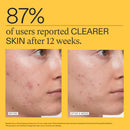 Nutrafol Clear Skin Acne Supplement for Women, Clinically Tested for Clearer, Smoother Skin, Physician-Formulated, Vegan Infinity Warehouse
