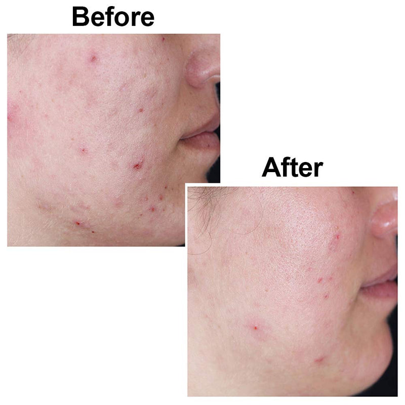 Original Kojie San Facial Beauty Soap - 100g, 3 Bars Per Pack - Guaranteed Authentic Kojie San