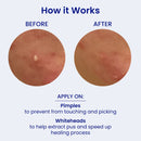 FaceTory Spot Fighter Acne Blemish Patches for Pimples (150 Counts)- Day and Night Options, Hydrocolloid Patches for Acne Spot Treatment (2 Sizes Each Pack) FACETORY