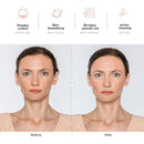 NewWay High Frequency Facial Therapy Wand Machine with 4 Argon Tube for Skin Tightening, Acne Treatment, Wrinkle Reducing Hair Follicle Professional Facial Beauty NewWay