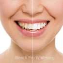 Teeth Whitening Gel Syringe Dispensers 22% Carbamide Peroxide, 10 Tooth Bleaching Gel 3ml Syringes Bleach Pro Whitening
