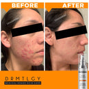 DRMTLGY Acne Spot Treatment and Cystic Acne Treatment. Acne Serum with Micronized Benzoyl Peroxide 5% and Glycolic Acid DRMTLGY