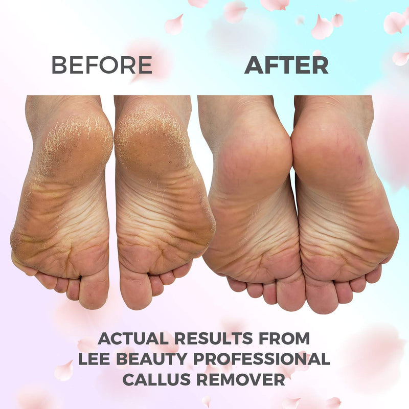 Lee Beauty Professional Callus Remover Extra Strength Gel for Feet, at Home Pedicure Results, 8 Oz LeeBeauty Professional