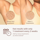 Philips Lumea 9000 Series IPL Hair Removal Device - Alternative to Laser Hair Removal, SenseIQ Technology and Lumea App, 4 Attachments for Body, Face, Bikini & Underarms, for Women & Men, BRI984/03 Infinity Warehouse