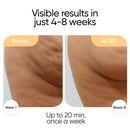 Sensica Sensifirm Radio Frequency Skin Tightening Device for Body – RF Body Sculpting Tool for Thighs & Buttocks, Firming & Smoothing, Cellulite Remover For Legs, At-Home Skincare Machine Infinity Warehouse