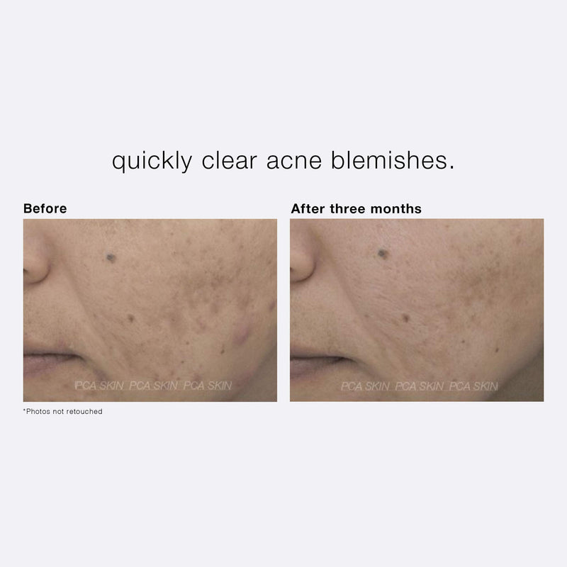 PCA SKIN Acne Treatment Cream for Face - Fast-Acting Daily Facial Spot Treatment with 5% Benzoyl Peroxide & Hydrating Lactic Acid for Acne-Prone Skin (0.5 oz) PCA SKIN
