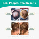 Shapiro MD Hair Growth Experts Leave-In Daily Foam, DHT Fighting Vegan Formula for Thinning Hair Developed by Dermatologists, Experience Healthier, Fuller & Thicker Looking Hair, 1 Month Supply Infinity Warehouse