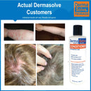 Scalp Psoriasis & Dandruff Shampoo and Conditioner by DermaSolve | Seborrheic Dermatitis Shampoo & Conditioner - Naturally Heals Itchy Flakey Inflamed Skin and Provides Soothing Moisturizing Relief Dermasolve
