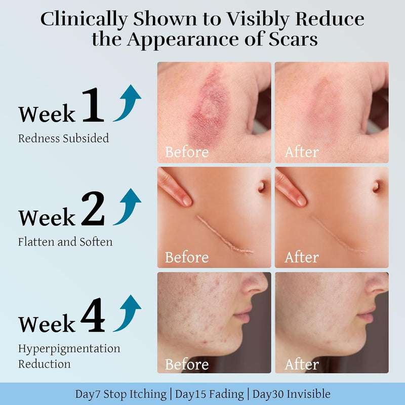 Advanced Scar Cream, Scar Reduction Treatment for Improves Skin Texture & Helps Remove Acne, Surgery, C Section, Burn, Keloid & Hypertrophic Scars 1.76 Oz (50g) Infinity Warehouse