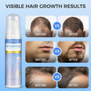 5% Minoxidil Foam for Men & Women, Hair Regrowth Treatment for Thinning Hair & Beard Growth, Extra Strength Topical Foam, Clinically Proven Hair Loss Treatment, 6 Month Supply (14OZ Total) Infinity Warehouse