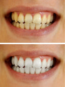 Teeth Whitening Gel Syringe Dispensers 22% Carbamide Peroxide, 10 Tooth Bleaching Gel 3ml Syringes Bleach Pro Whitening