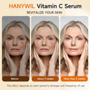 HANYWIL Super Vitamin C Serum for Women over 70, Vitamin C Serum for Face, Dark Spot Remover for Face, Hyaluronic Acid Skin Care, Targets Age Spots, Hydrates and Wrinkle Reduction 1.7fl oz Infinity Warehouse