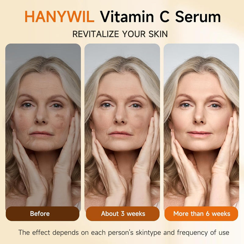 HANYWIL Super Vitamin C Serum for Women over 70, Vitamin C Serum for Face, Dark Spot Remover for Face, Hyaluronic Acid Skin Care, Targets Age Spots, Hydrates and Wrinkle Reduction 1.7fl oz Infinity Warehouse