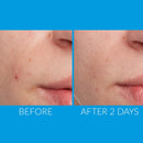 Kate Somerville EradiKate Acne Treatment | Clears Pimples Fast & Prevents Breakouts | Sulfur Spot Treatment | 1 Fl Oz Kate Somerville