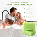 Roycederm Antifungal Antibacterial Tea Tree Soap: Antifungal Antibacterial Treatment for Face & Body Acne, Athlete's Foot, Tinea, Folliculitis Ringworm Jock Itch (Pack of 1) Infinity Warehouse