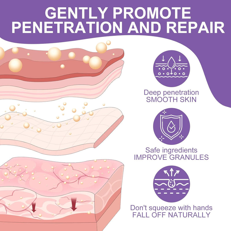 Milia Remover Cream for Eyes and Face,Milia Spot Remover with Salicylic Acid ,Milia Acne Cream (1 Fl Oz (Pack of 1)) Infinity Warehouse