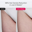 Ulike Laser Hair Removal Device Air 10 Ipl Gift for Women and Men, Ice Cool and Permanent Hair Reduction for Nearly Painless, Dual Lights, Skin Sensor & USHR Mode Hair Removal in 10mins from Home Infinity Warehouse